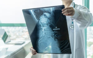 How Anderson Injury Lawyers Can Help If You’ve Suffered a Spinal Cord Injury in Fort Worth, TX