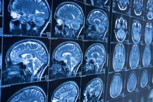 ¿Por qué elegir a Anderson Injury Lawyers para que te ayuden a reclamar compensación tras sufrir una lesión cerebral en un accidente en Austin, Texas?